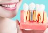 How Dental Implants Can Improve Your Oral Health