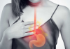 Does everyone who has heartburn have acid reflux?