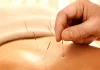 Common Myths Surrounding Acupuncture and Its Potential Health Benefits.