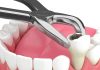 How to Prevent Dental Extractions