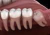 Wisdom Tooth Extraction’s Common Indicators